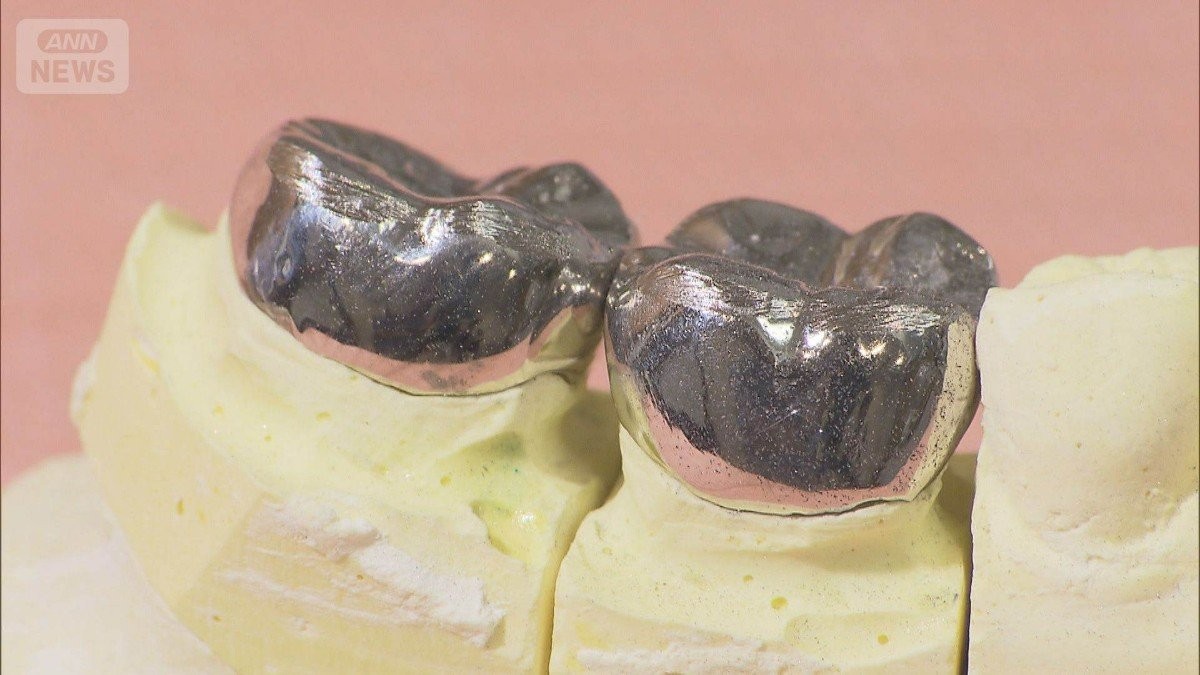 「銀歯治療するほど赤字」貴金属高騰で歯医者ピンチ　1本あたり3000円自腹