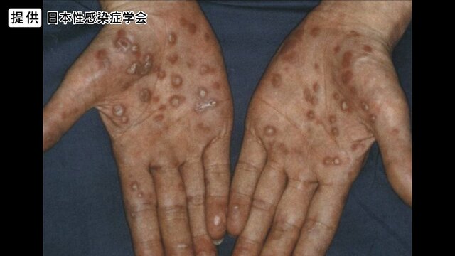 梅毒急増　マッチングアプリでの出会いが一因か　男20～40代、女20～30代　長野で過去最多