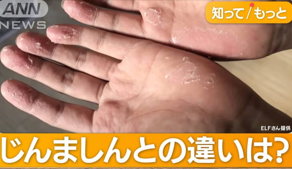 「寒冷じんましん」食器洗いでも突然発症…寒さに反応か　医師「冷たい飲み物も注意」