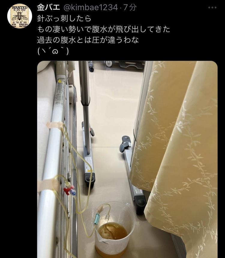 【速報】金バエさん、腹水の様子が変わってしまう