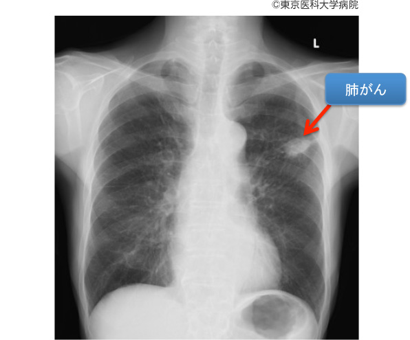 【研究】肺がんの72% は喫煙が原因・・・ロンドン大学教授 「肺がん患者のうち、10年以上生存する人は10％未満です、この状況は変わらなければなりません」