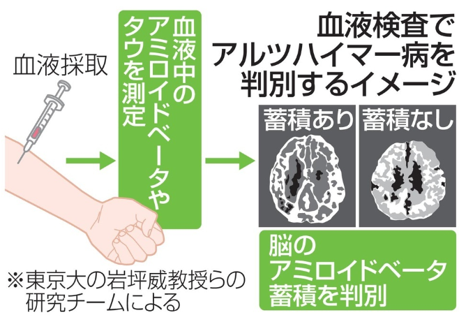 血液検査で認知症判別　無症状、早期の診断期待