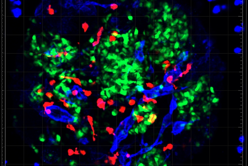 【米ウェイル・コーネル医学部研究】新型コロナウイルスが膵臓細胞を破壊する、糖尿病を引き起こし悪化させる