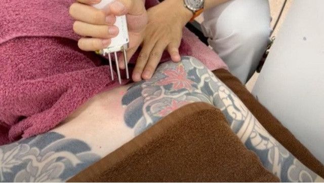【時事】タトゥー・刺青除去専門医が明かす十人十色なワケアリ事情…「推し変したので消したい」「憎い人間を足裏に入れて毎日踏んだけど…」