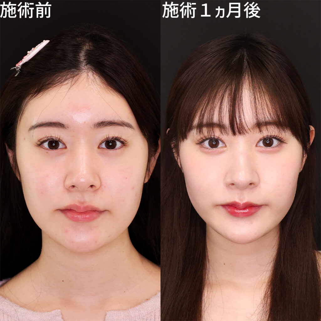 元NGT48メンバーが500万整形の箇所を赤裸々告白「人生早めに可愛くなってうれしい」