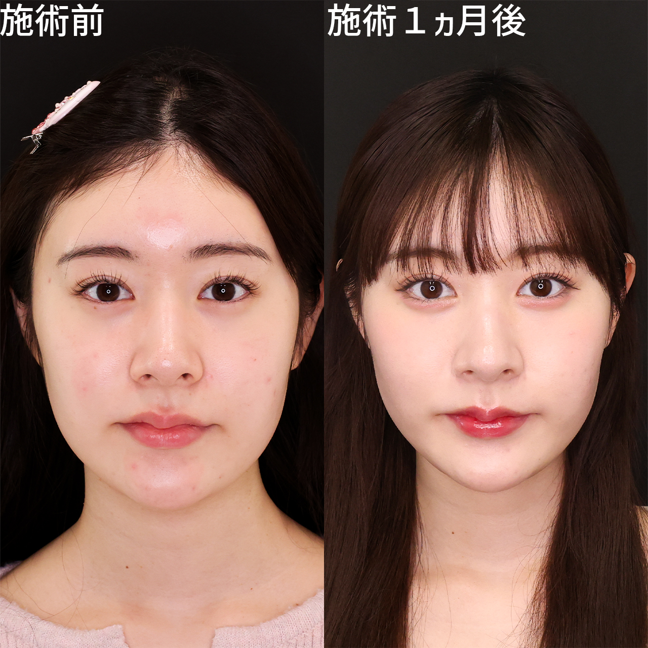 元NGT48メンバーが500万整形の箇所を赤裸々告白「人生早めに可愛くなってうれしい」
