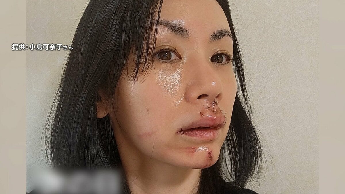 【芸能】タレント・小島可奈子さんの顔を犬が“ガブリ”「傷跡が残ります」医師が断言…30針も縫う大けが