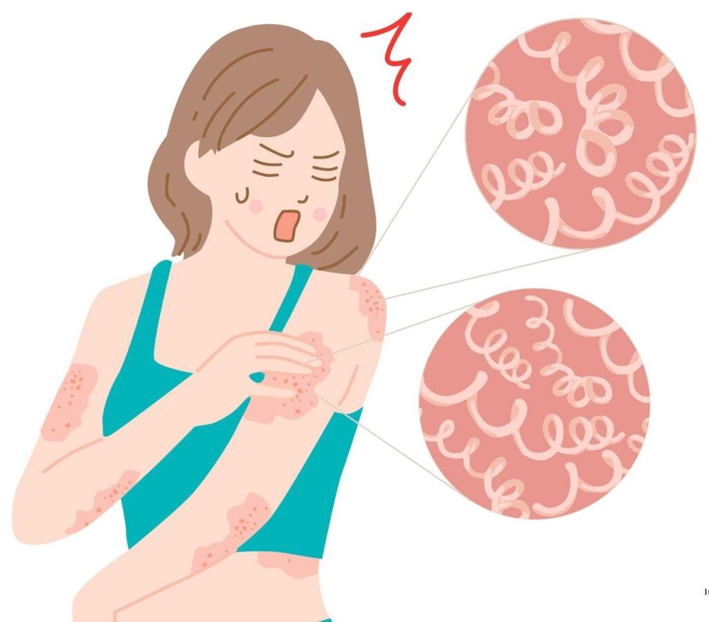 キスするだけで感染も。50年に一度の大流行期に入った"梅毒"