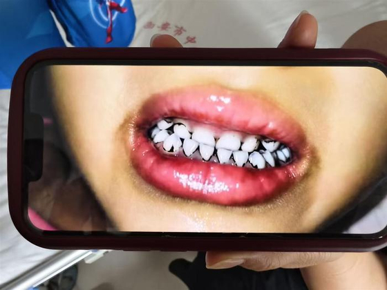 【中国】幼稚園児の髪が突然抜け、歯が黒くなる…集団鉛中毒発生