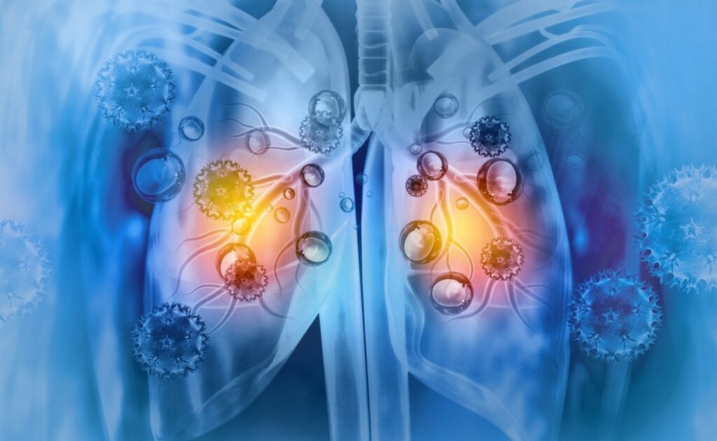 【国際的な研究】新型コロナ感染が休眠中の乳がん細胞を目覚めさせ、再発リスクを高める・・・ハザード比は1.41倍