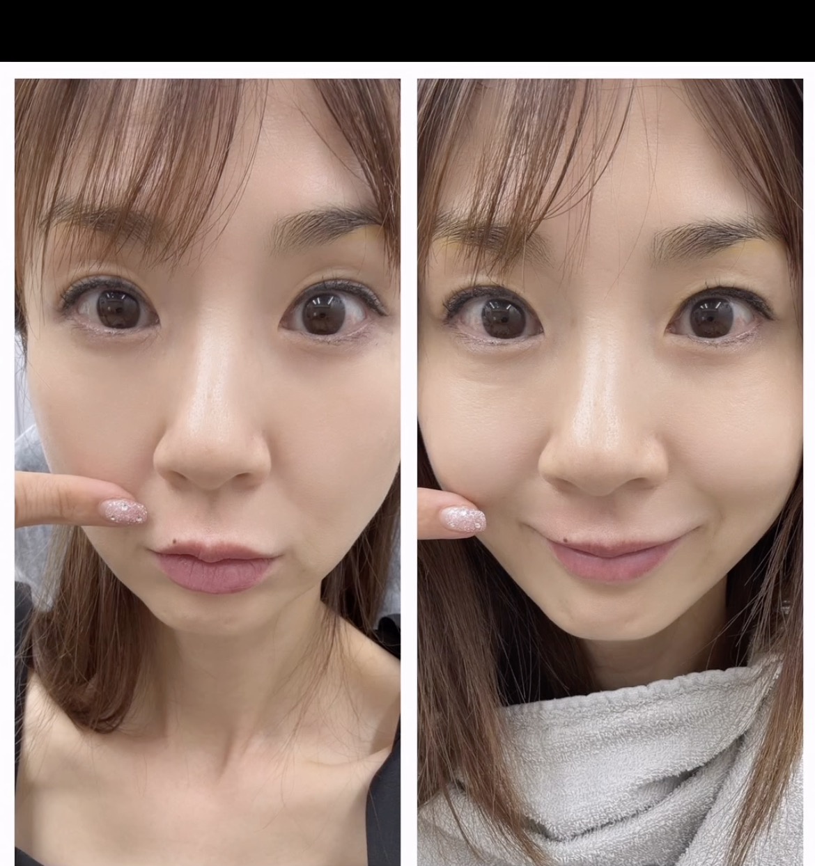 【芸能】ほしのあき「人中短縮レーザーを受けてきたよ」「1ミリちょっと短くなりました」ビフォアフに衝撃