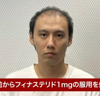 【画像】薄毛治療薬のフィナステリド、ガチで効果がすごいwwww