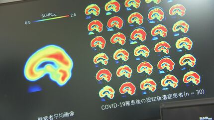 【新型コロナ】「ブレインフォグ」解消の糸口掴む コロナ後遺症患者の脳を分析「アンパ受容体」の密度が健常者より高いと判明 横浜市立大