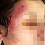 【美容整形】鼻が変形、慢性痛にしびれ、壊死に死亡例も…５年で５倍！「美容医療後遺症」の現場から医師の警告