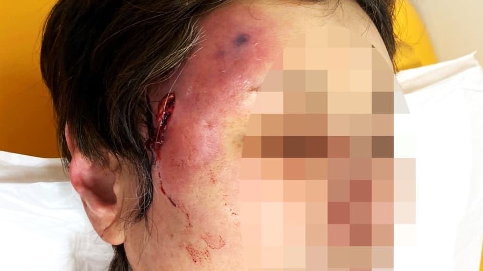 【美容整形】鼻が変形、慢性痛にしびれ、壊死に死亡例も…５年で５倍！「美容医療後遺症」の現場から医師の警告