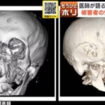【TV】NHK『きょうの健康』異例の内容が話題　「クマから命を守る！」…「ネタかと」「恐ろしい時代」「顔面の骨砕けてるCTまじで怖い」
