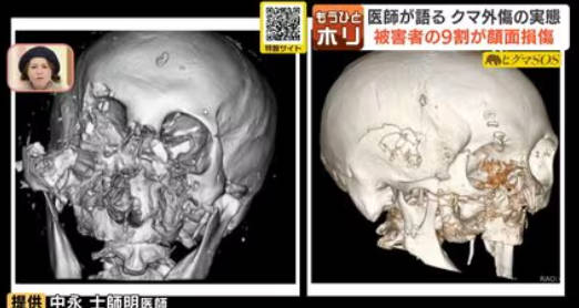 【TV】NHK『きょうの健康』異例の内容が話題　「クマから命を守る！」…「ネタかと」「恐ろしい時代」「顔面の骨砕けてるCTまじで怖い」