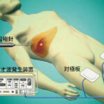 【癌、超音波で45分治療（肝癌に有効）】日本での販売・導入の開始を意味するもので、すぐに全国の病院で誰でも受けられるわけではありません