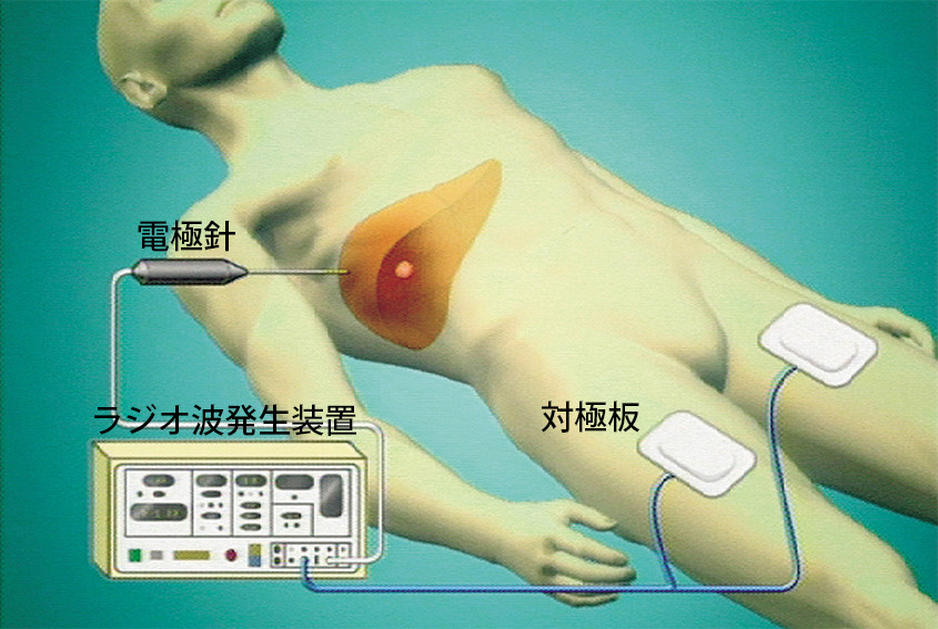 【癌、超音波で45分治療（肝癌に有効）】日本での販売・導入の開始を意味するもので、すぐに全国の病院で誰でも受けられるわけではありません