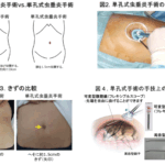 虫垂炎の手術で患者の体内に「ビニール袋」を置き忘れ　痛みを訴え発覚→再手術で摘出