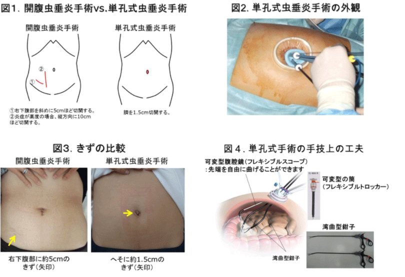 虫垂炎の手術で患者の体内に「ビニール袋」を置き忘れ　痛みを訴え発覚→再手術で摘出
