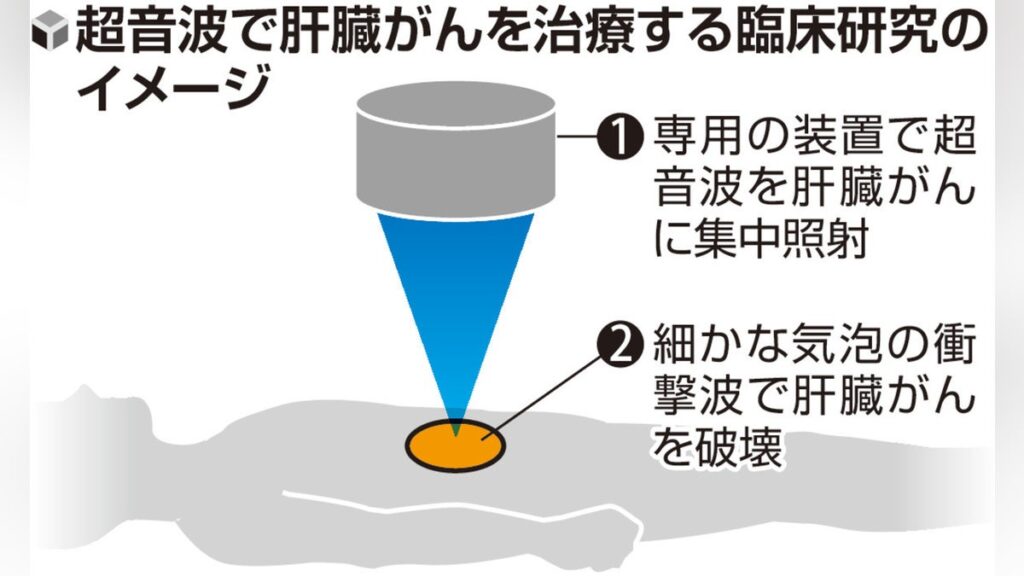 【ヒストトリプシー】超音波で肝臓がん細胞を破壊、大阪公立大が臨床実験開始・・・メスや針使わず治療「実用化されれば多くの患者に朗報」