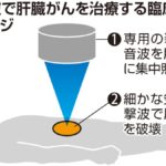 【ヒストトリプシー】超音波で肝臓がん細胞を破壊、大阪公立大が臨床実験開始・・・メスや針使わず治療「実用化されれば多くの患者に朗報」