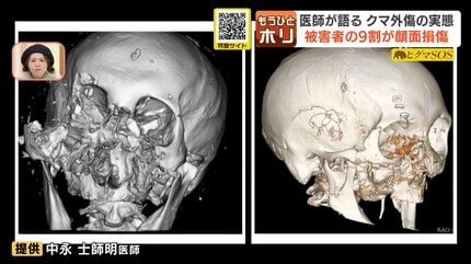 【クマ襲撃】被害者の9割が顔面損傷…鼻がなくなり骨は粉砕「体を大きく見せようと立ち上がって…」