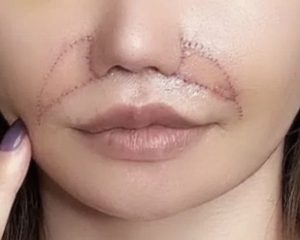 【注意】「目の下のくま取り治療が原因で失明しかけた人も」片目縮小、顔がボコボコ…美容整形によるトラブルが急増しているワケ