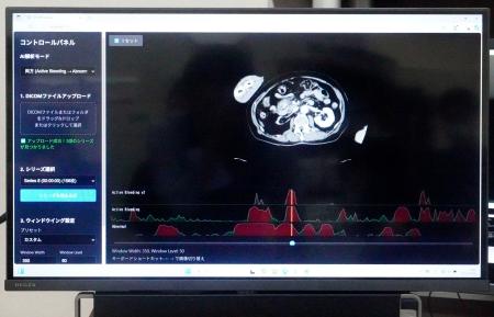 【医療AI】けがCT画像 “10秒でAI分析”　的確に「止血」、迅速な治療期待