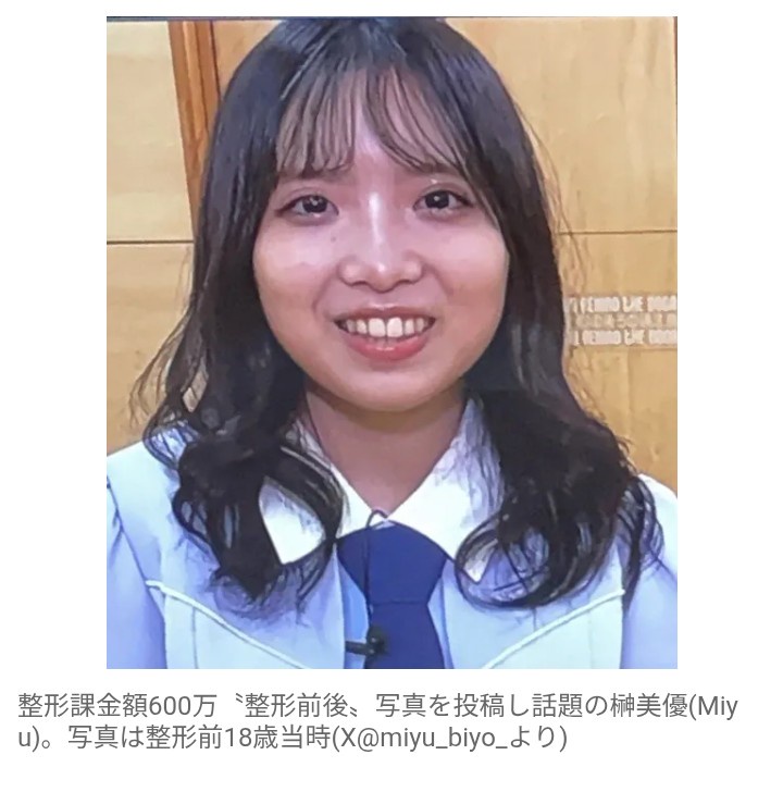 【芸能】整形課金額600万円　元STU48・榊美優、激変ショットに反響続々  「もう別人だし大成功」​「すごい変化だね」