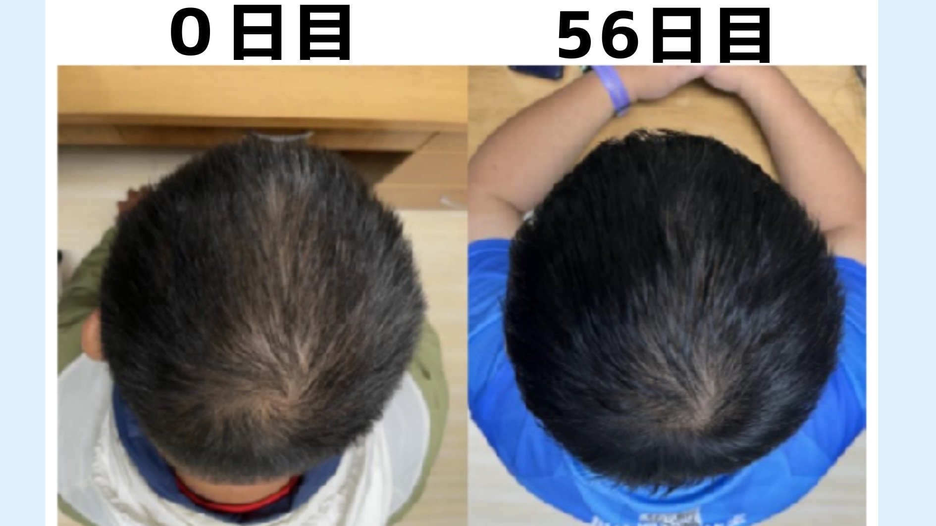 【京大】8週間で髪を「太く・多く・長く」する植物エキスを開発