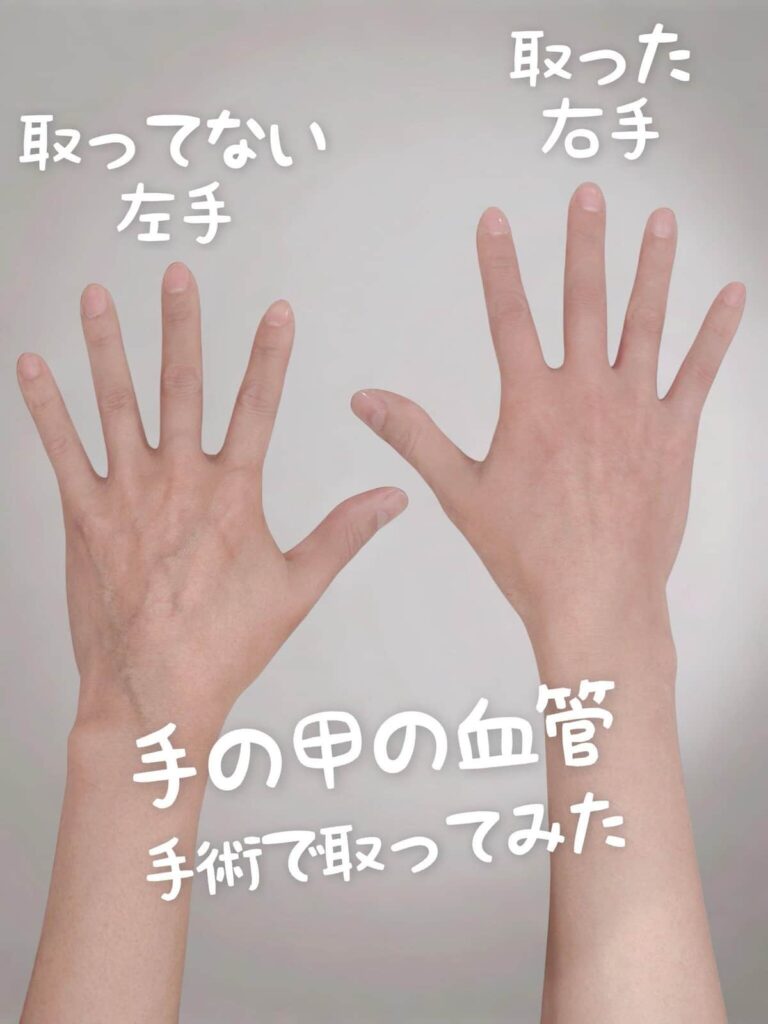 女装モデルでミュージシャンの男性(48)「手に浮き出た血管を取る」手術告白　ネット賛否も「私の判断で施術」