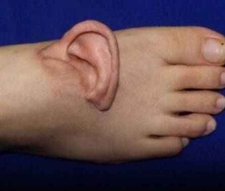 手術で左耳を足の甲に付けた女性が、動画を公開