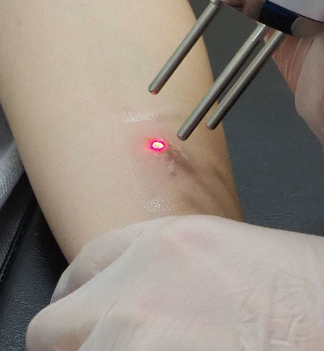 【ファッション】『消えるタトゥー』「最高にかわいい」と流行の裏でSNS上に?不安の声?も…　「正しい知識をもって」と専門家も警鐘