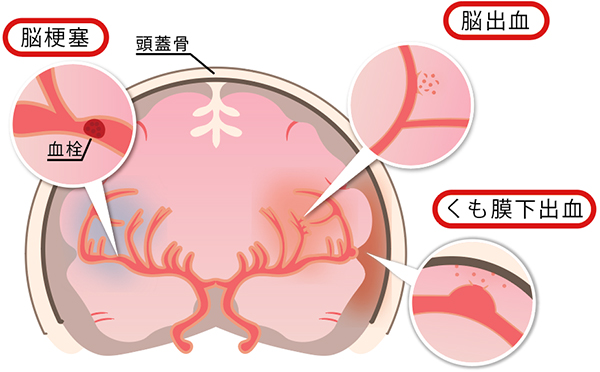 【医療】脳卒中などの治療成功率を50%から90%に向上